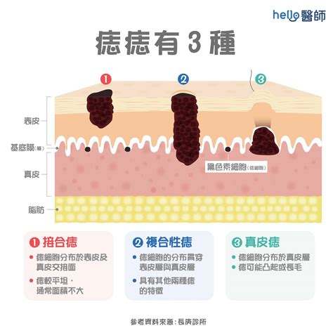 脖子長黑痣|痣形成的原因？痣長毛、痣變多變大是痣病變？5招判別